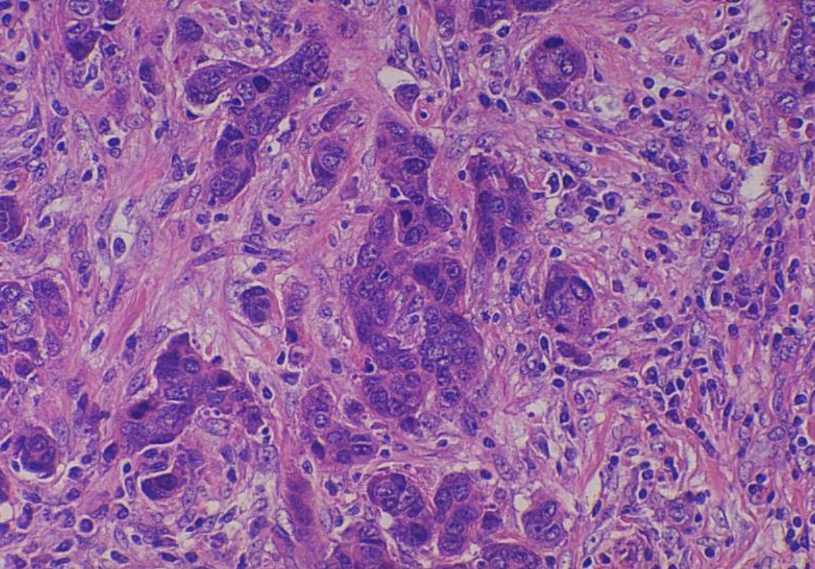 Tissue Microarray's and their impact in Medicine