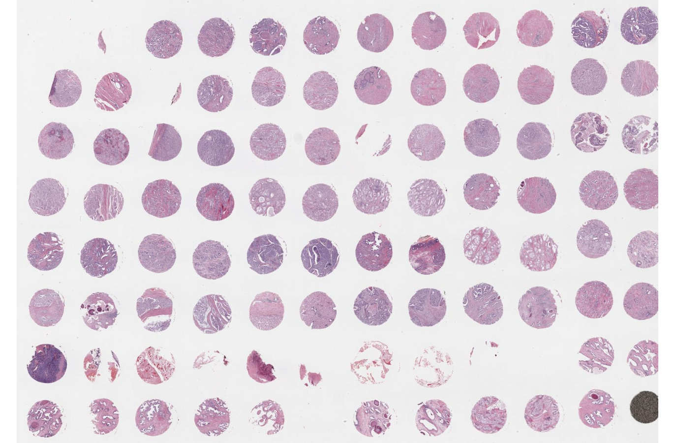 Traditional Biopsy Techniques vs. Tissue Microarray