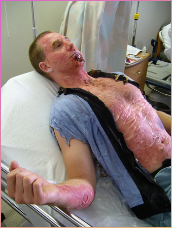 2nd degree burn for triage exercise.jpeg