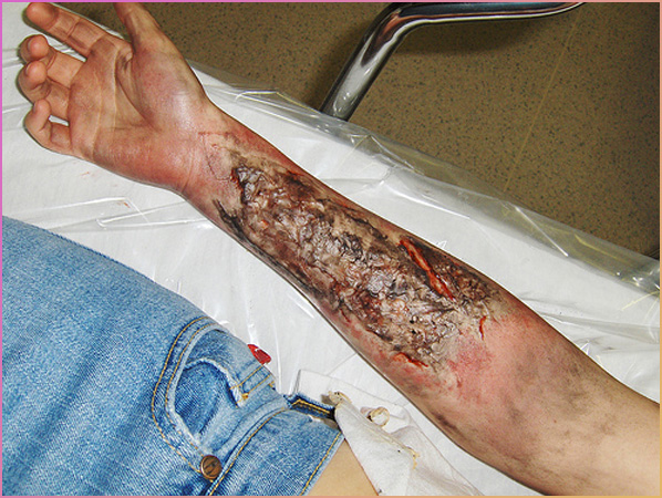 3rd degree burn for a triage exercise.jpeg