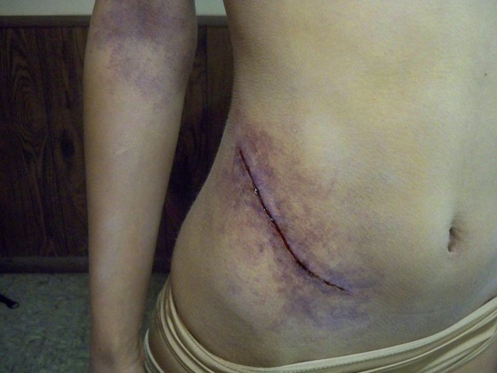 kidneyincision.jpeg