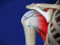 Shoulder Conditions →