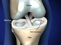 Knee Conditions →