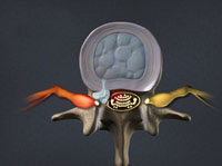 → Herniated Discs 