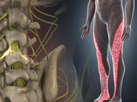 → Sciatica