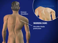 → Scoliosis