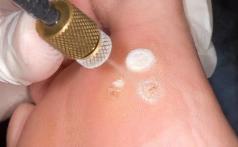 Dr Shainhouse uses cryotherapy to treat warts at SkinSafe Dermatology and Skin Care