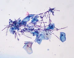Candida, Liquid-based Pap (Photo credit: euthman )