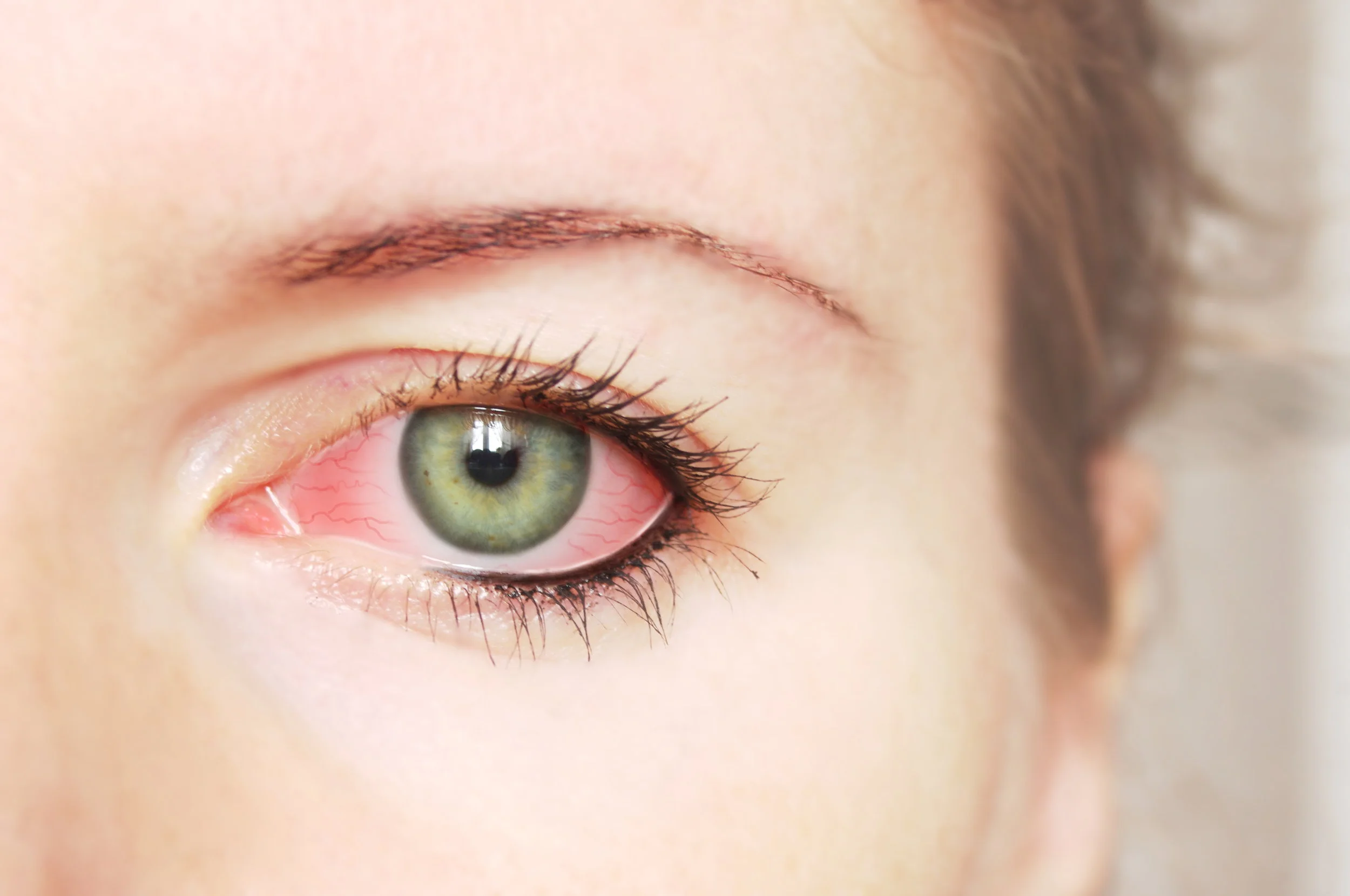 Home Remedies for Pinkeye