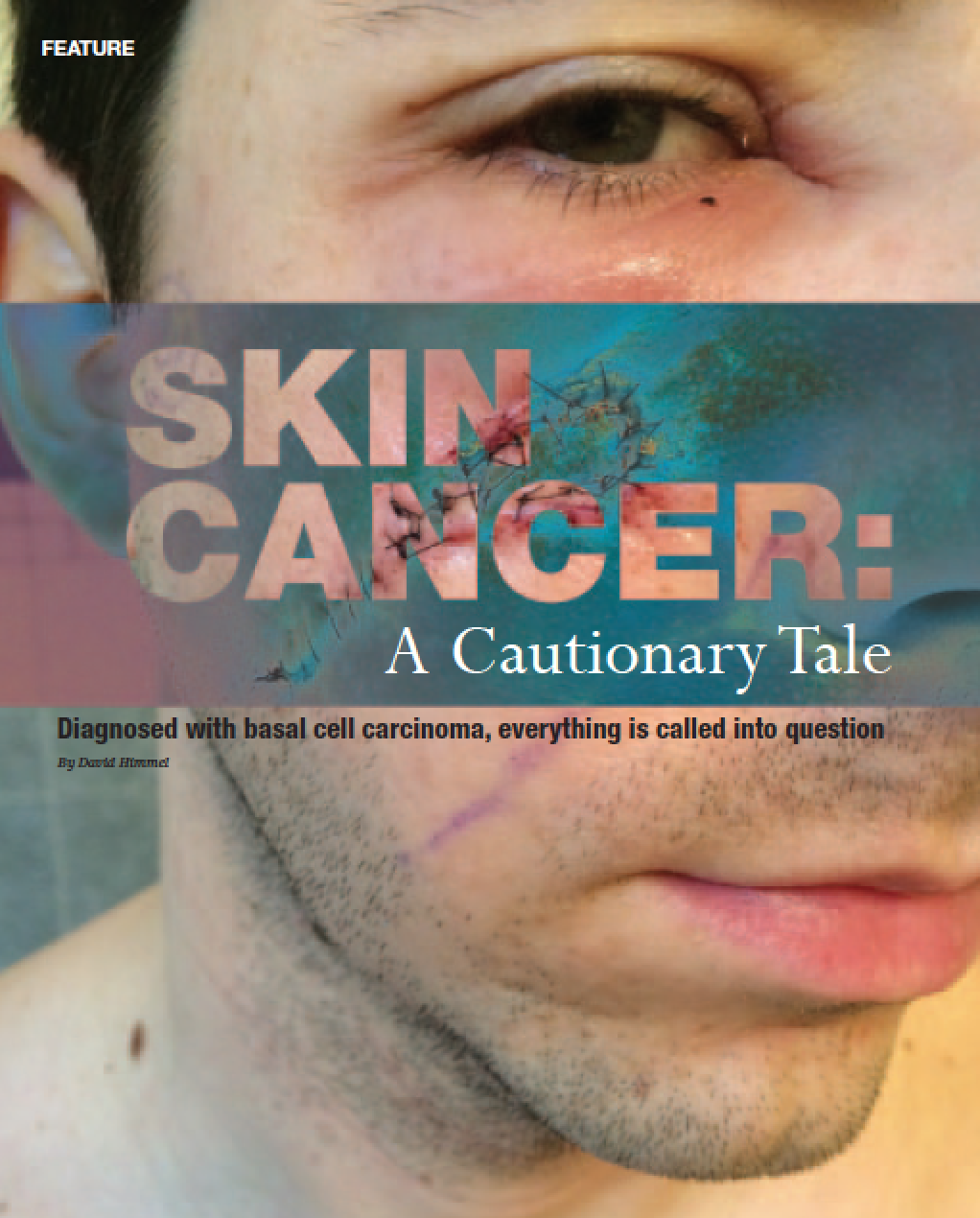 Skin Cancer: A Cautionary Tale Chicago Health — Journalism