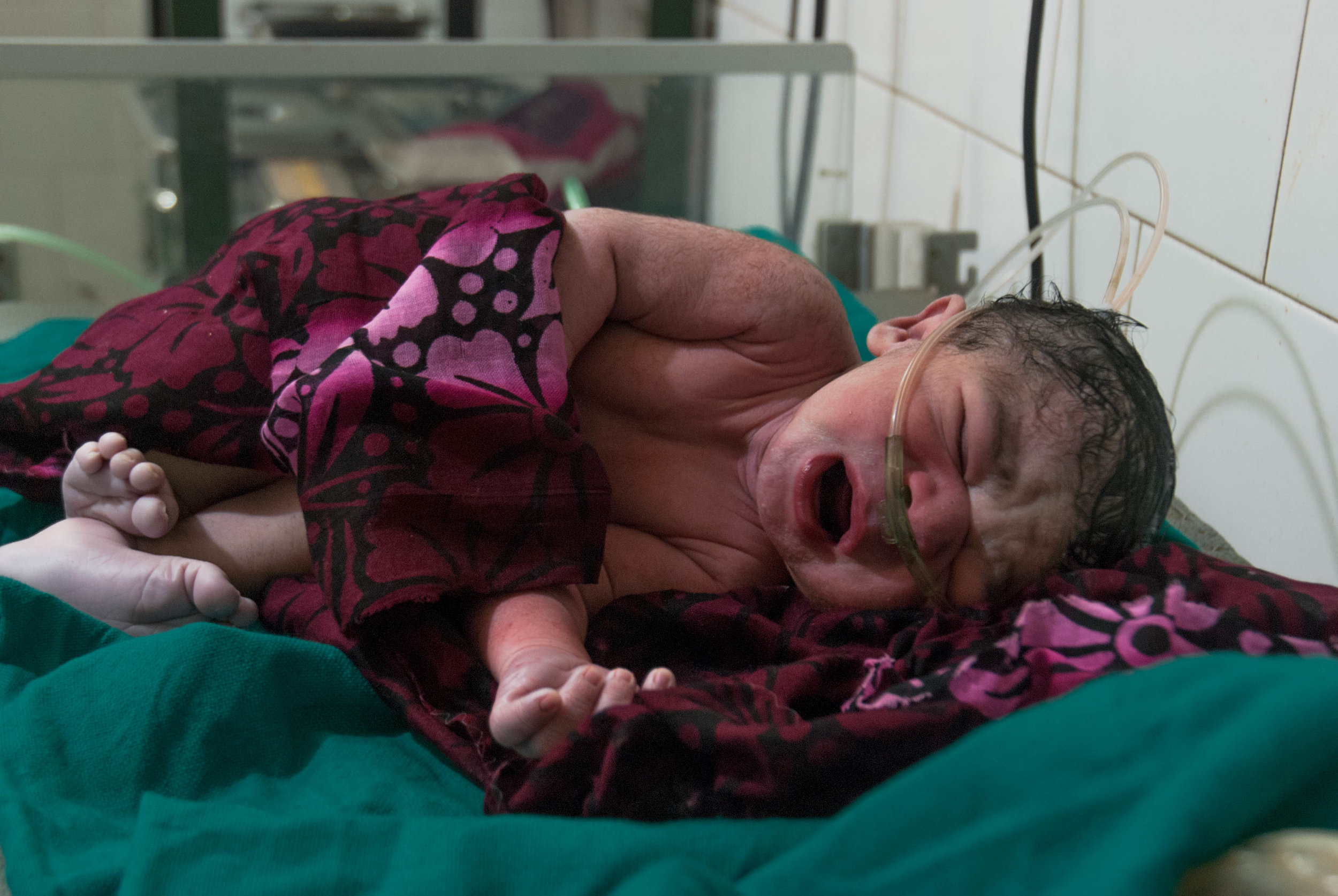  A newborn from a breech delivery cries out for his first breath of air.&nbsp; Breech deliveries can be fatal for children not born with medical care. 