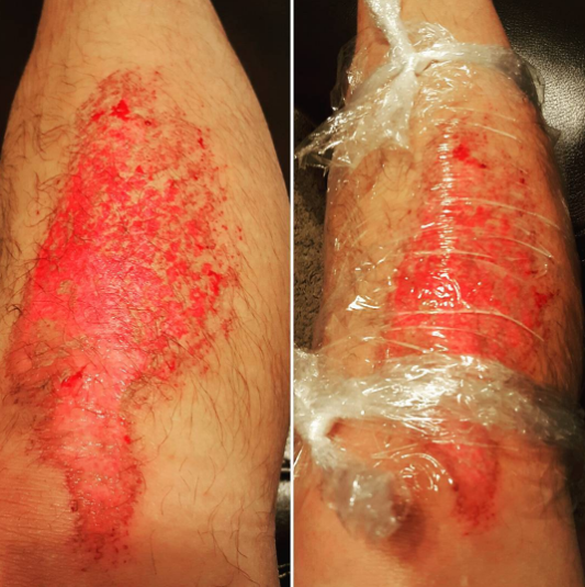  Remember to learn your first aid, kids. Thank you boy scouts.&nbsp;#turfburn#occlusivedressing #firstaid #meritbadge#saranwrap #bacitracin 