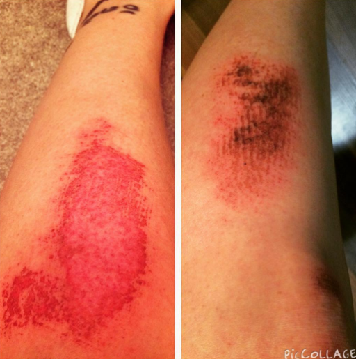  Almost exactly a year apart. Same spot.&nbsp;#ouch #soccer #turfburn #scars 