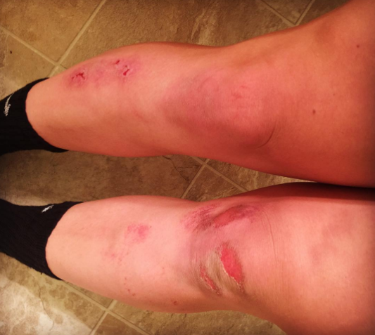  Must be soccer season again #toreup #turfburn #ksusoccer #gk#soccergirlprobs #keeper 