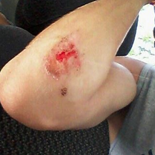  Minor football injuries are ugly.&nbsp;#footballseason #turfburn #ugly 