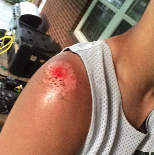  I didn't like this shoulder either...&nbsp;#lacrosse #VestalUnited #TurfBurn 