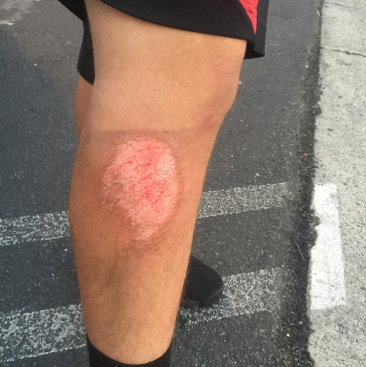  Casualty of football. Raudel got really bad turf burn today during practice#football #deanzahighschool#turfburn 