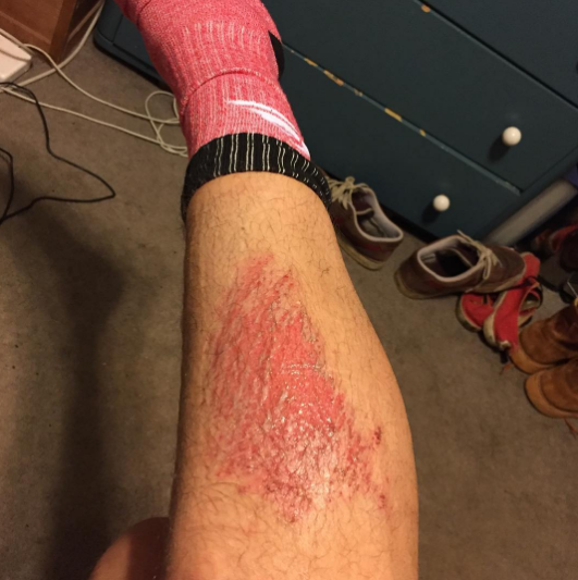  Play soccer kids. It's fun.&nbsp;#turfburn#soccer #slidetackle 