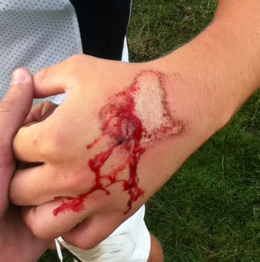  Sick#blood#turfburn#football#jorgen 