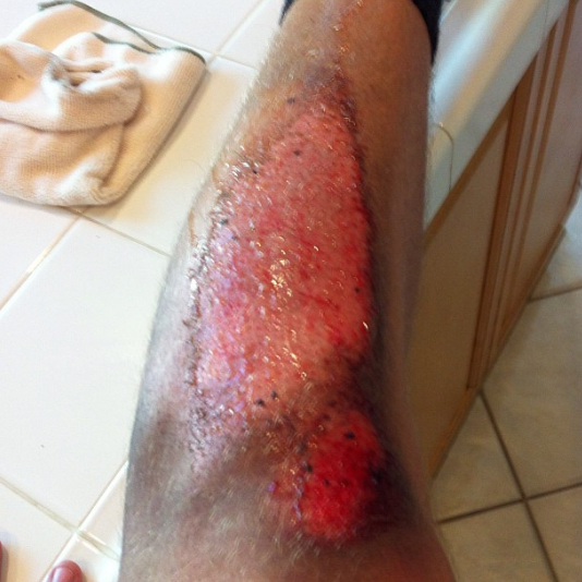  #tbt to when i destroyed my leg sliding for a kickass ultimate frisbee catch #ultimate #turfburn 