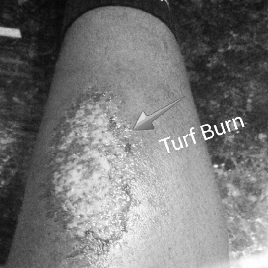  Turf Burn sucks #turfburn#painful #stings #burning 