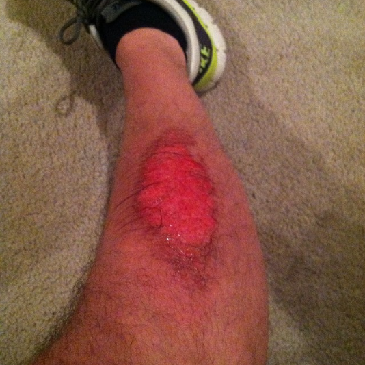  The one thing I don't miss about football.&nbsp;#turfburns #rubbingalcohol#futurebaldspot 