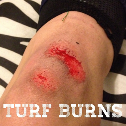  Hate them! A new one from tonights practice!&nbsp;#soccergirlprobs #turf#burns #turfburns #soccer #soccerswag#bloody #cuts #hurts 