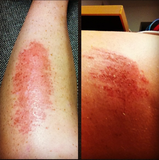  Life of a rugby player #turfburns #ouchh 