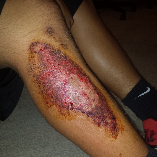  Josès turf burn. Damn #turfburn 