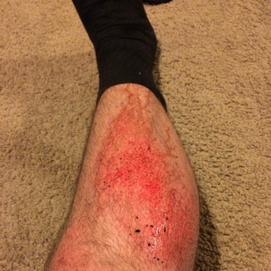  So I guess that's why you don't wear shorts on turf.&nbsp;#flagfootball#turfburn #imtoooldforthis 