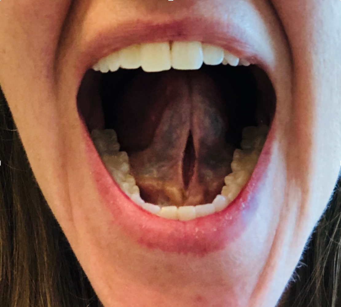 Tongue Ties — CFT The Gillespie Approach