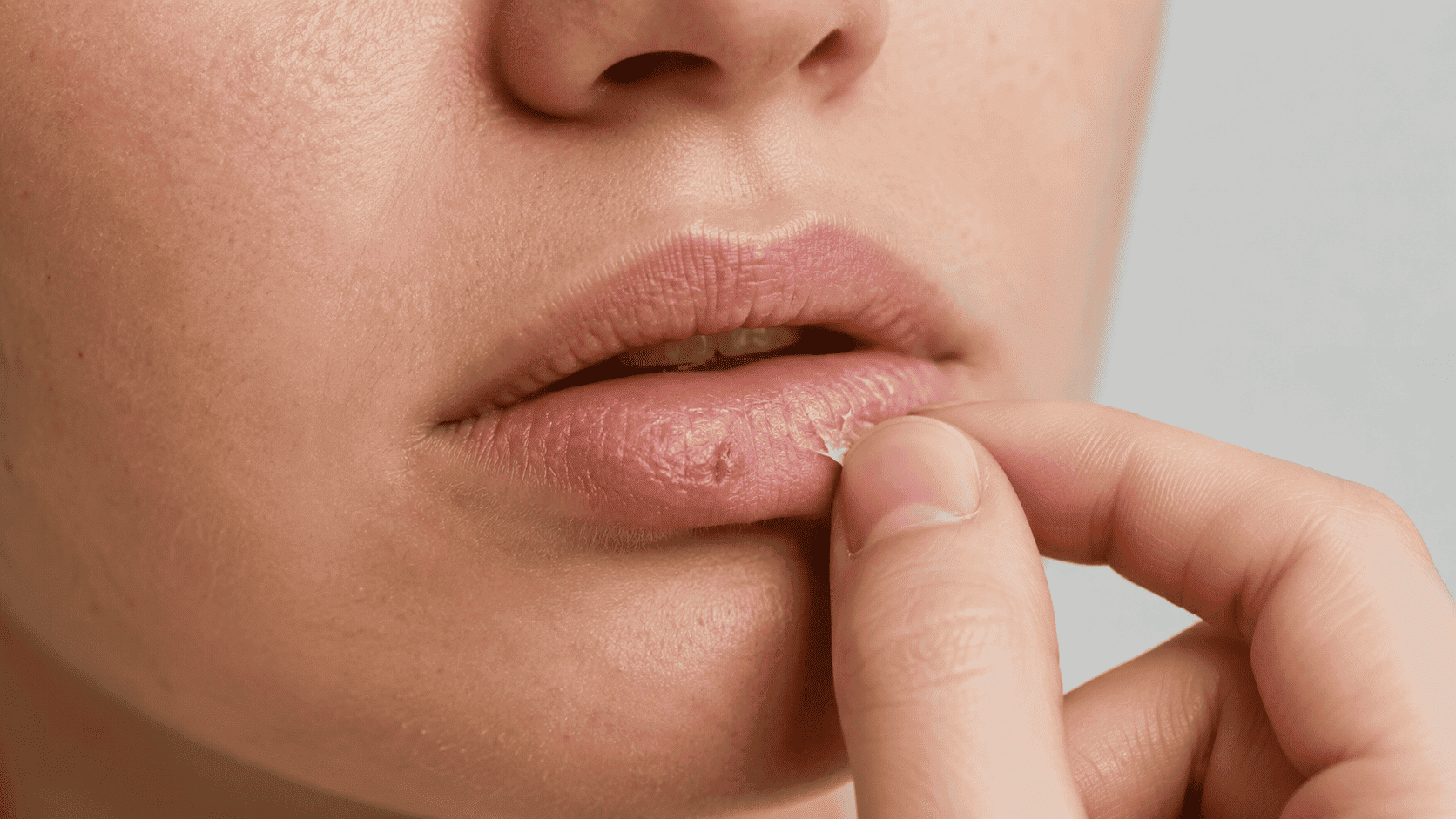 Kebiasaan Mengelupas Kulit Bibir Bikin Luka Makin Lama Sembuh