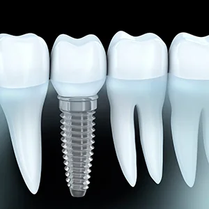 Dental Implant 300 300.jpg