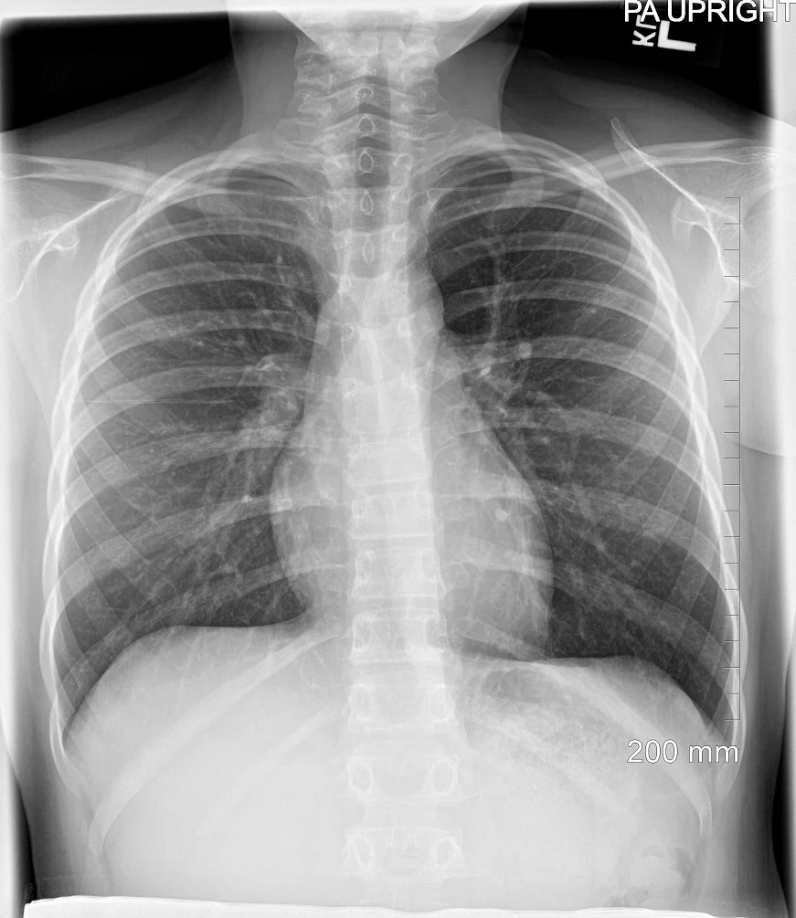 Normal Digital Chest X-ray