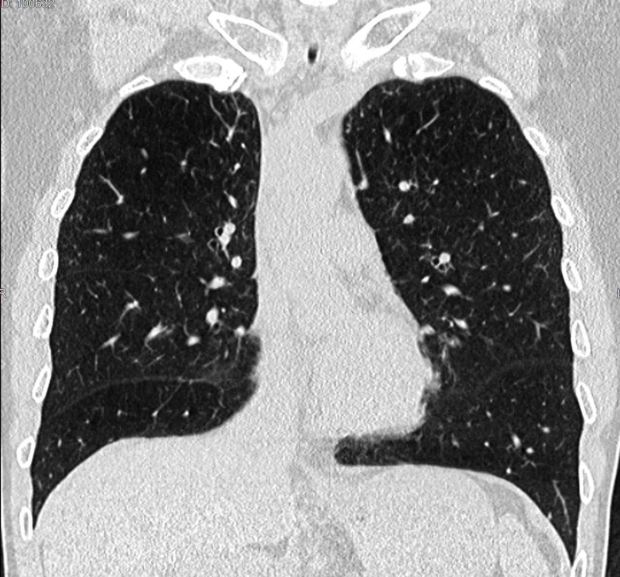 Low dose lung cancer screening CT