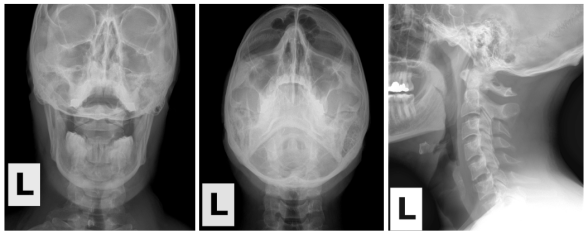 Upper cervical spinal correction - Straight Spine Chiropractic, Courtenay and Campbell River