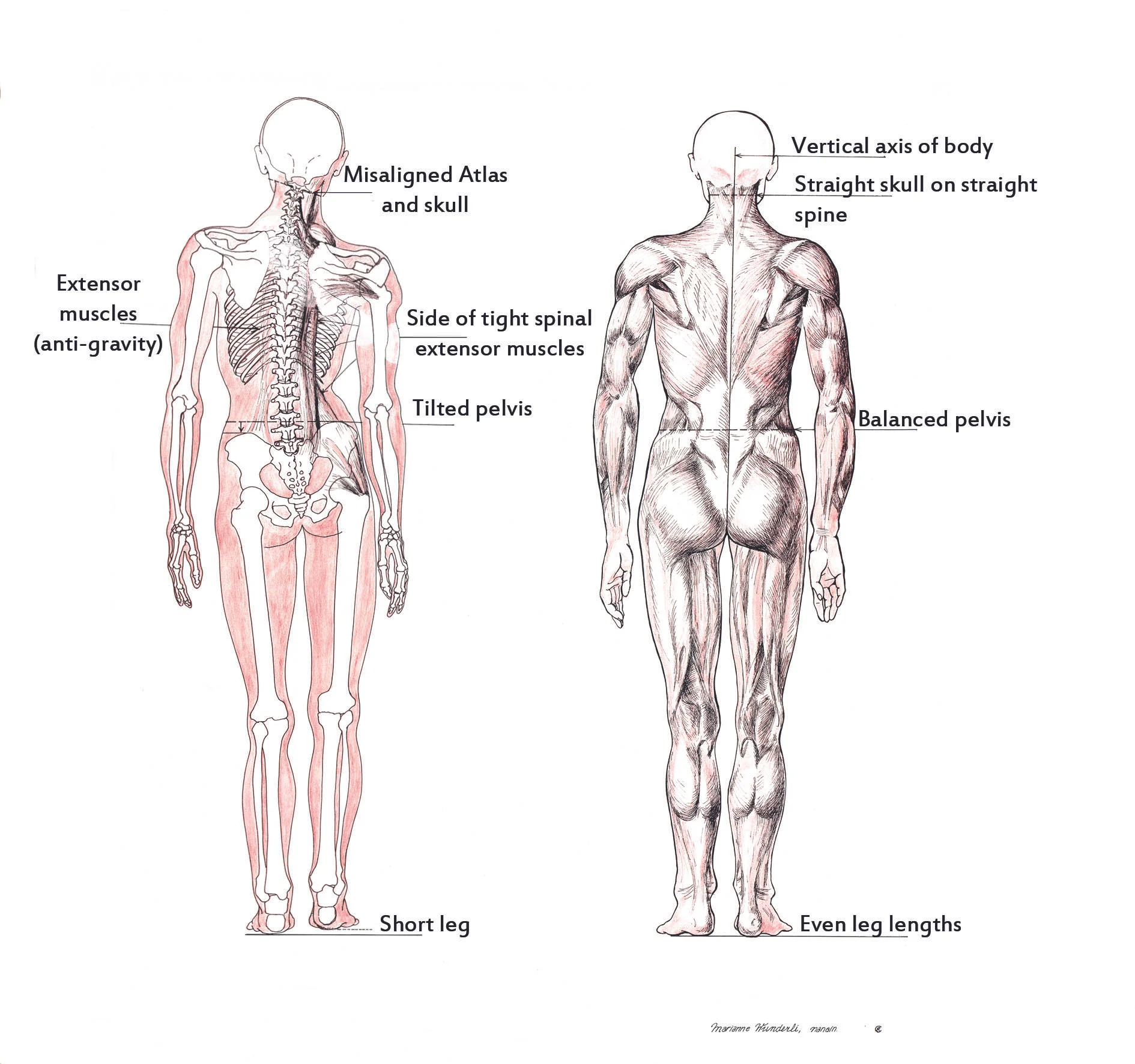 A misaligned spine can be treated by chiropractors Dr. Cockwill and Dr. Lee in Courtenay and Campbell River