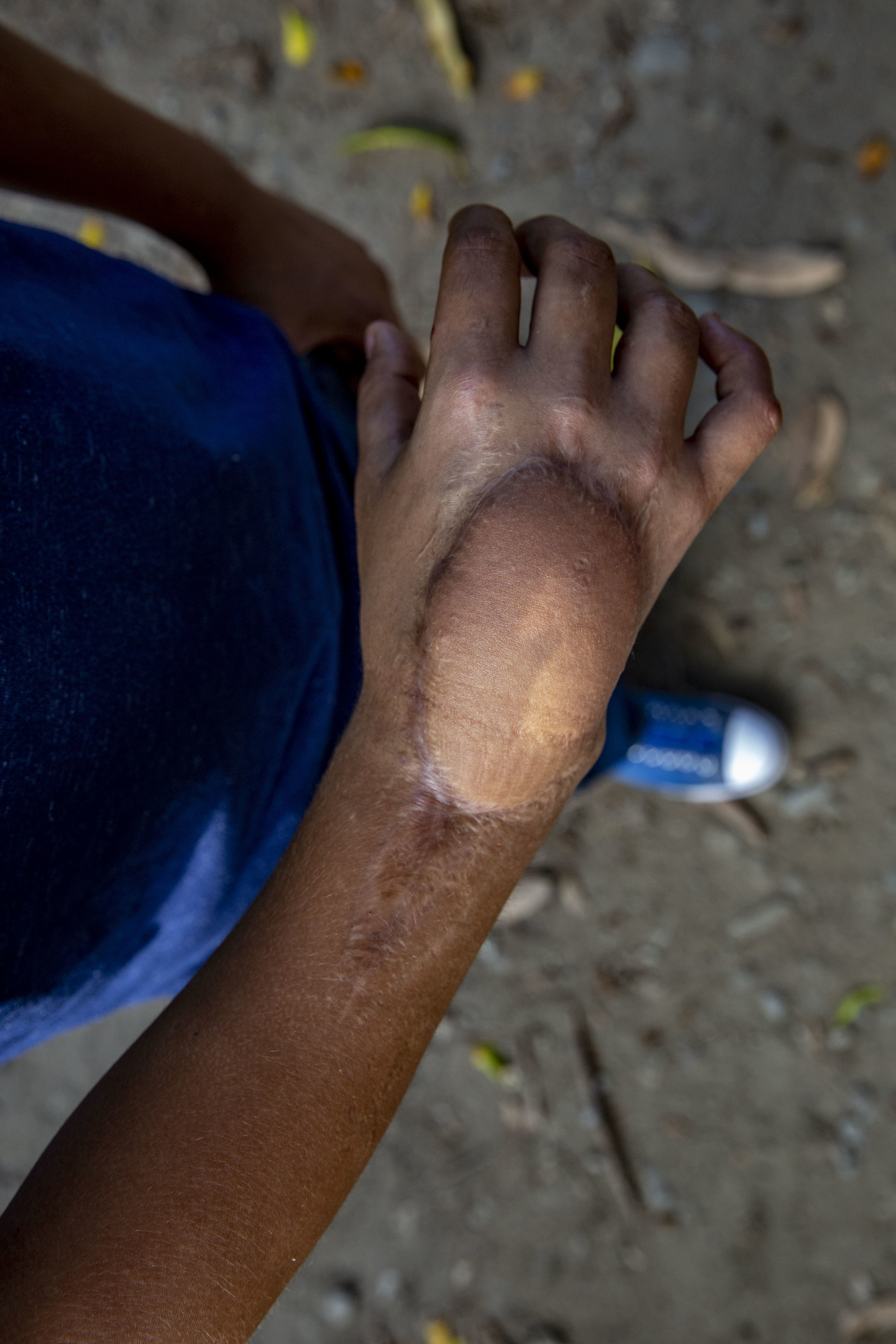 Christian Velasquez, he had several surgical operations after an car accident in 2012. Here in the courtyard of his house in San Pedro Sula, Honduras. He recevied extensive help from the Ruth Paz fundation.
