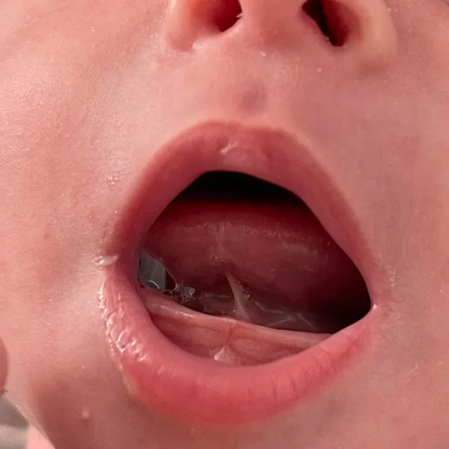 Is the surgical release of a tongue-tie the answer?