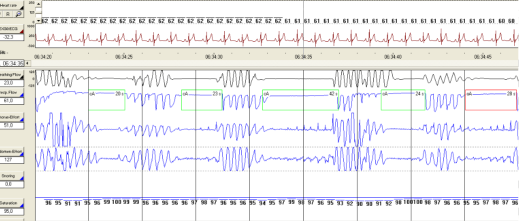 Polysomnography.png