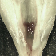 Standard Root Canal Treatment