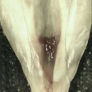 Root Canal after Standard Root Canal Treatment *