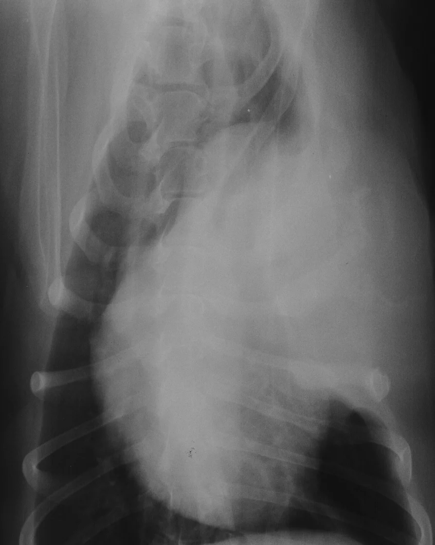 Bone Tumors Rib — DR. JULIUS LIPTAK