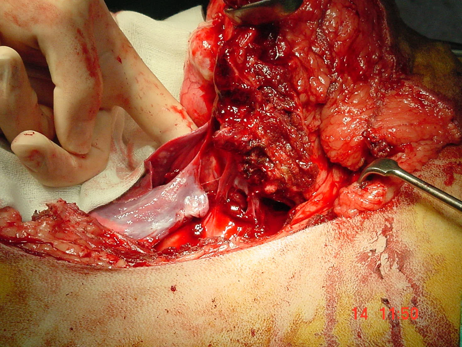 Bone Tumors - Rib — DR. JULIUS LIPTAK