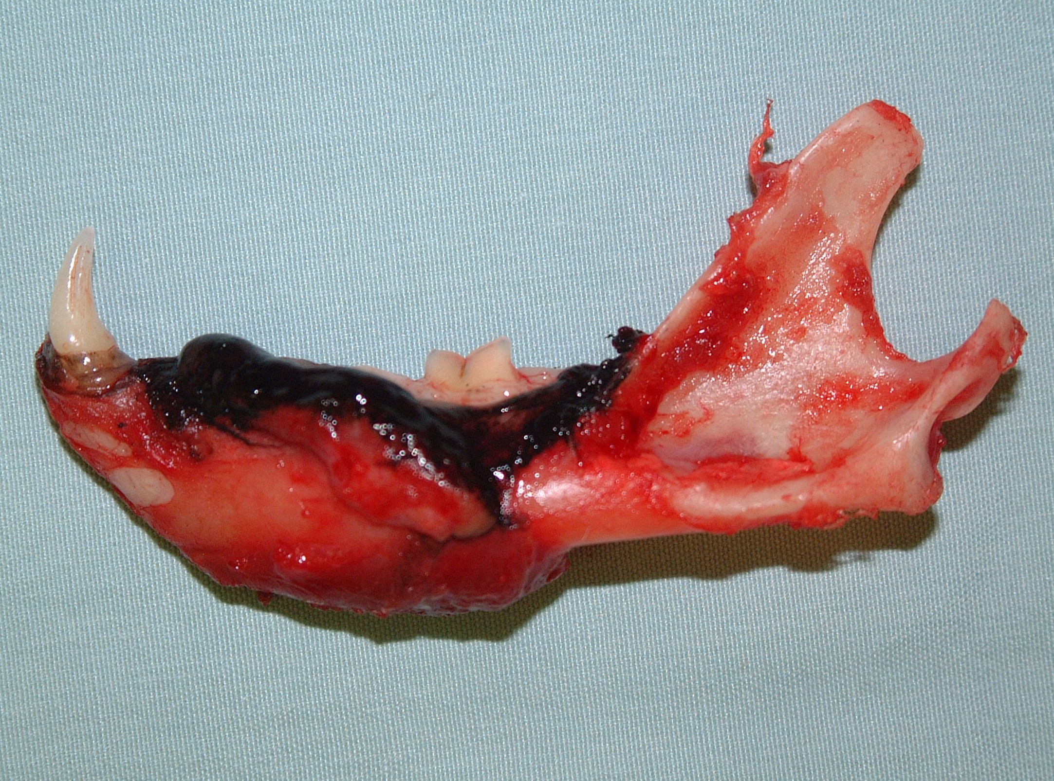 MANDIBULECTOMY