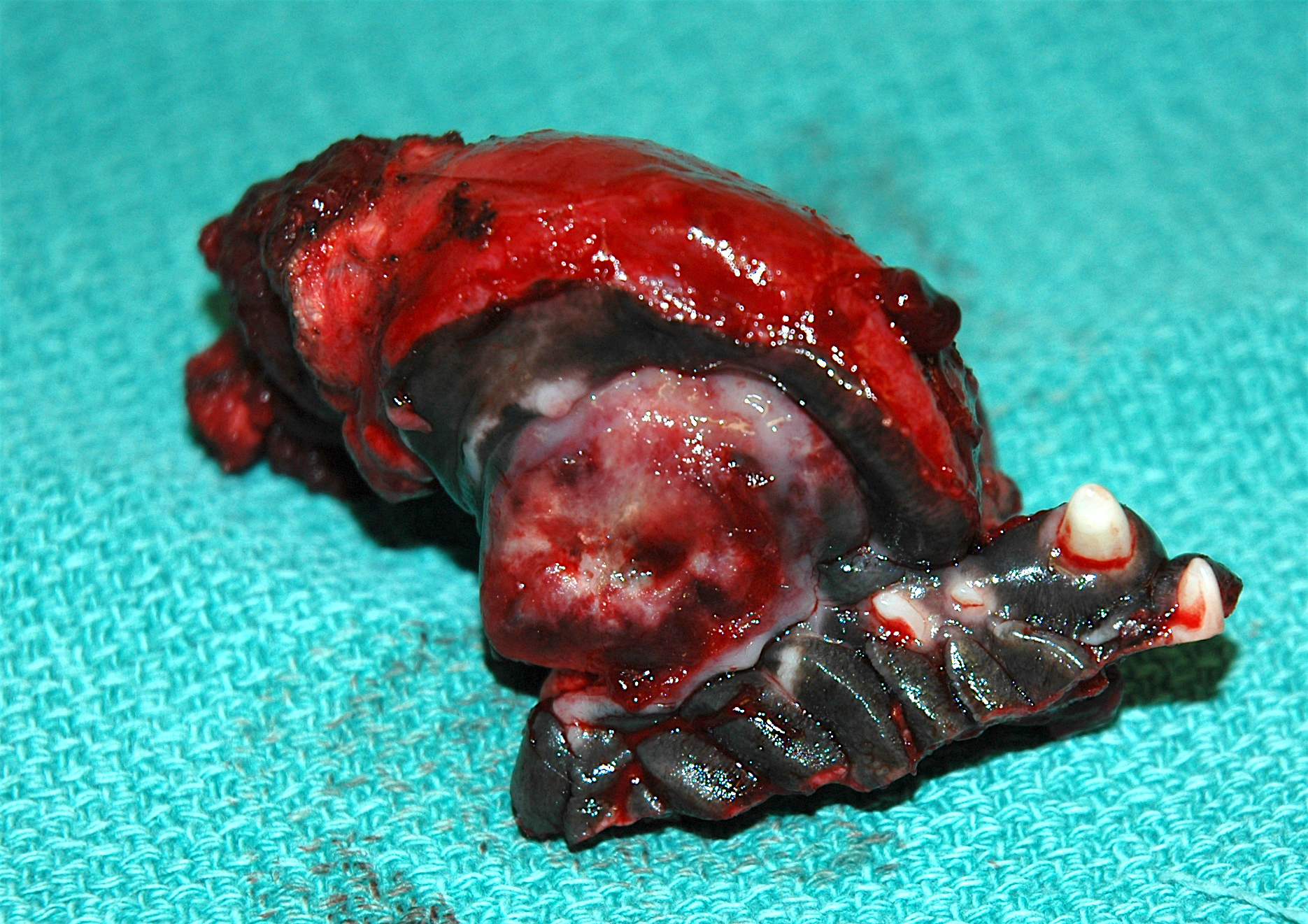 MAXILLECTOMY