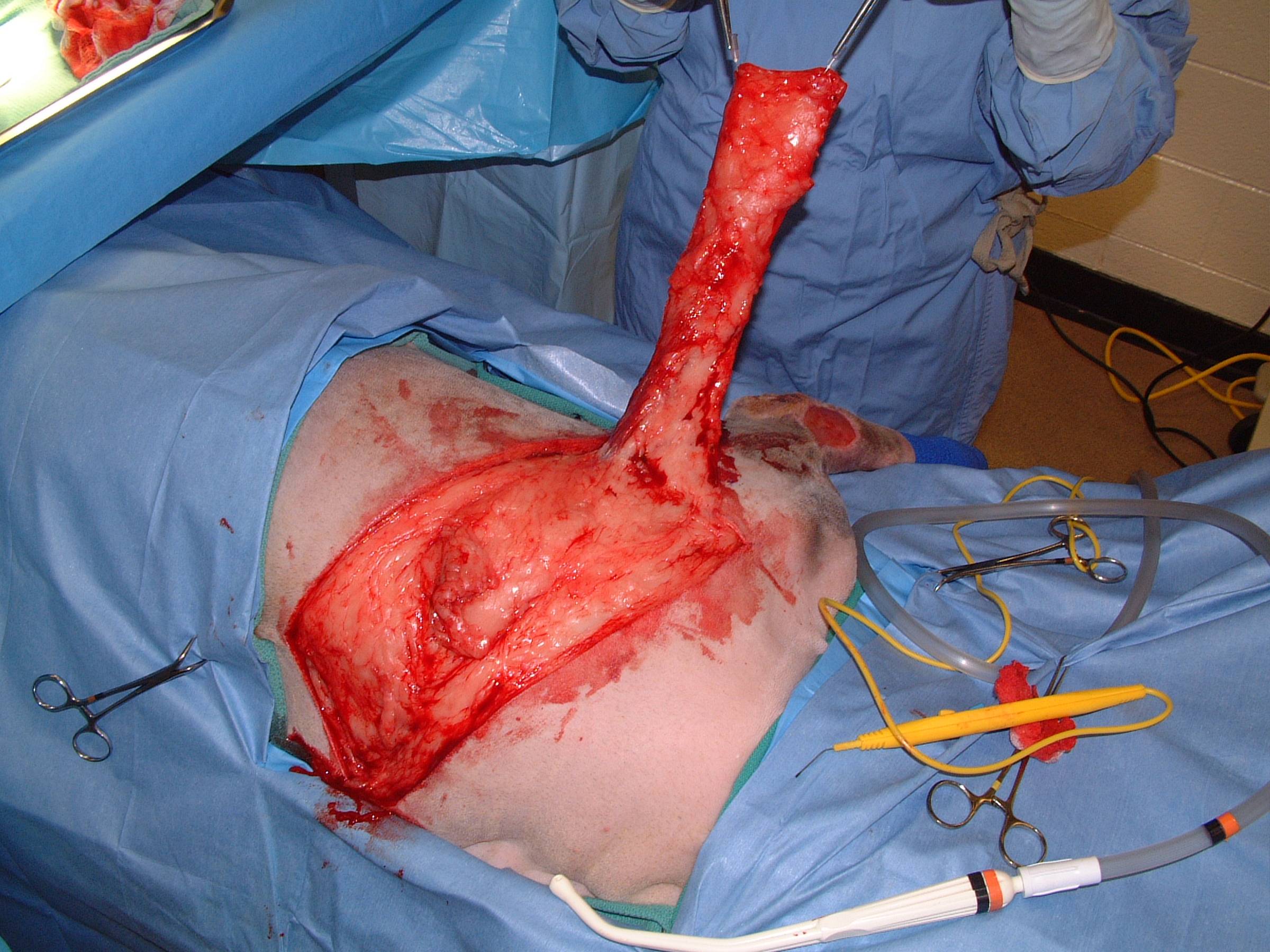 THORACODORSAL AXIAL PATTERN FLAP