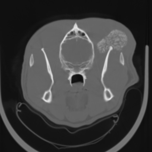 CAUDAL MANDIBULECTOMY