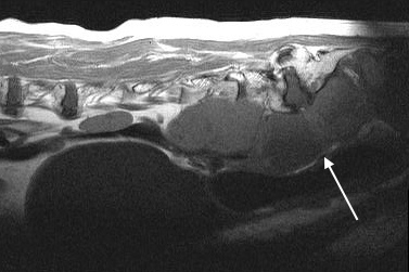 MRI - Sublumbar Lymph Node Metastasis (AGASAC)