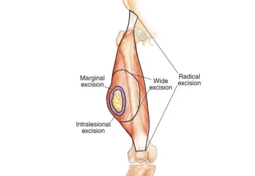 Marginal Excision Vs Incision Principles - Surgical Margins — DR. JULIUS M. LIPTAK